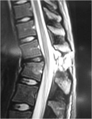 Metilprednisolona en lesión espinal aguda: revisión sistemática