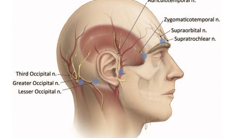 Bloqueo de cuero cabelludo (scalp) para cefalea postcraneotomía: resumen y bibliografía